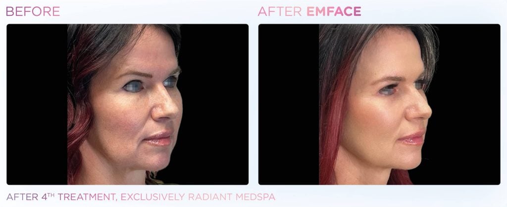 Side-by-side photos show a woman's face before and after EMFACE at our Medical Spa Nassau County.