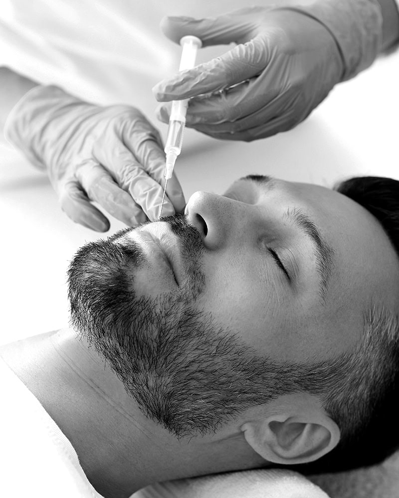 A bearded man receives microneedling in Nassau County from a gloved professional while lying down.
