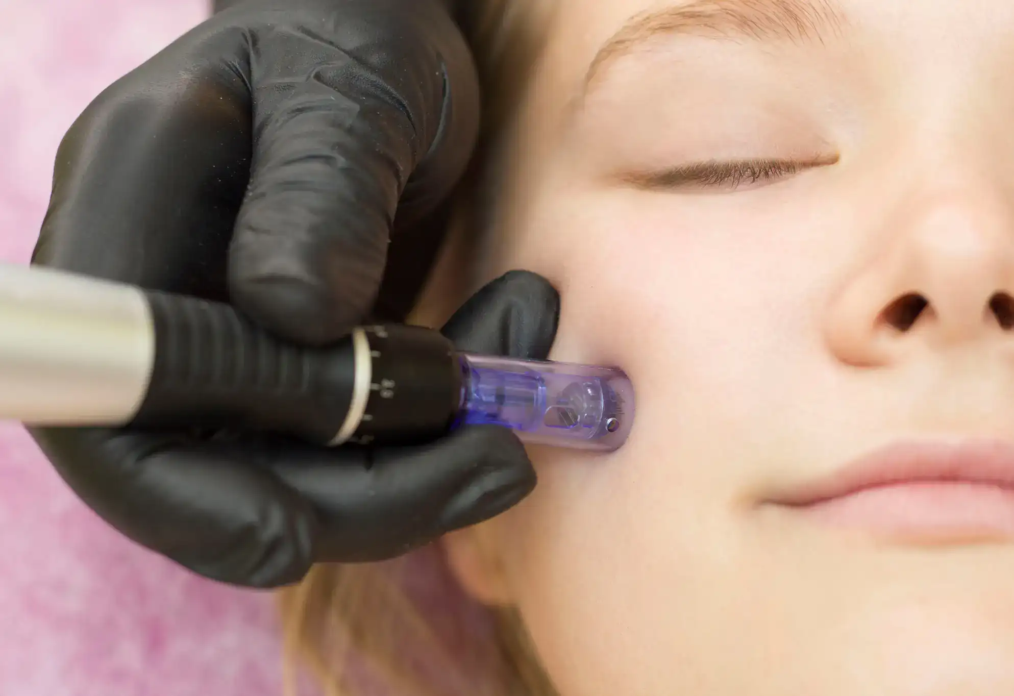 A gloved hand performs a microneedling facial treatment on a person's cheek in a skincare procedure.